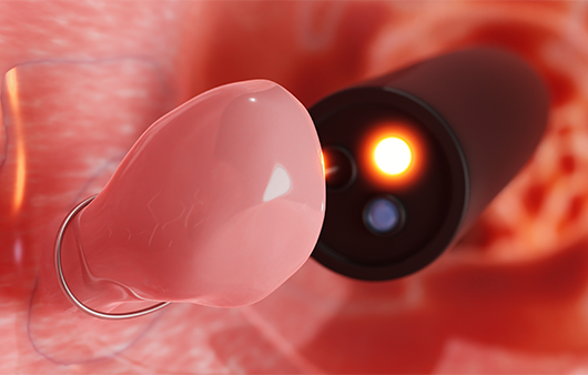 대장내시경｜출처:게티이미지 뱅크