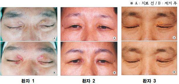 환자 1은 40대 남성, 환자 2는 60대 여성, 환자 3은 50대 남성. 어븀야그 레이저로 안검 황색종을 완전 제거한 모습.. 고려대 안암병원 제공