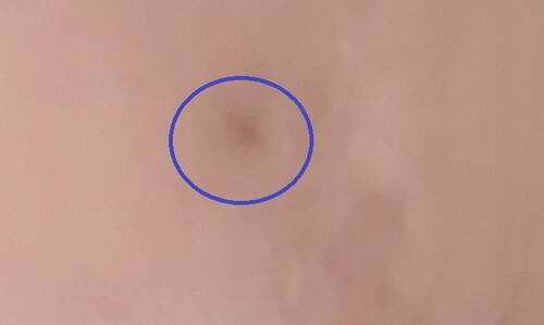 1980년 5월21일 공수부대 집단발포 때 옛 전남도청 인근에서 총격을 받은 김태연씨의 총탄 상처. 김태연씨 제공