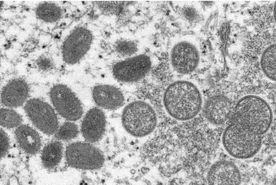 미국 질병통제예방센터가 공개한 전자현미경 사진에 인간의 피부 샘플에서 얻은 성숙된 타원형의 원숭이두창 바이러스(왼쪽)와 구형의 미성숙 바이러스(오른쪽)가 나타나고 있다. [이미지출처=연합뉴스]