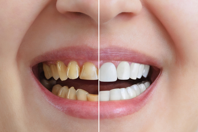 사진설명=치아 미백제는 치아 혹은 잇몸이 약해진 상태에서 사용하면 치아 과민증, 이 시림, 치아 신경 손상, 잇몸 질환 등의 부작용을 가져올 수 있어 사용에 주의해야 한다./사진=게티이미지뱅크