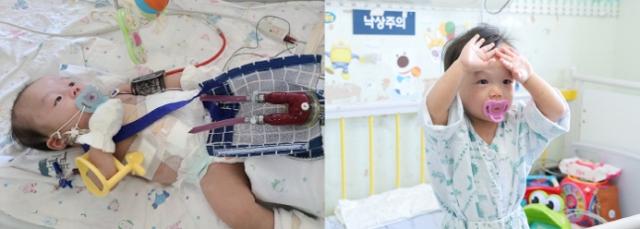 선천적으로 심장 질환을 앓는 권순후 아기가 체외형 심실보조장치를 넣고(왼쪽) 400일 간 유지한 끝에 심장 기능을 회복하고 건강한 모습으로 퇴원을 앞두고 있다. 서울대병원 제공