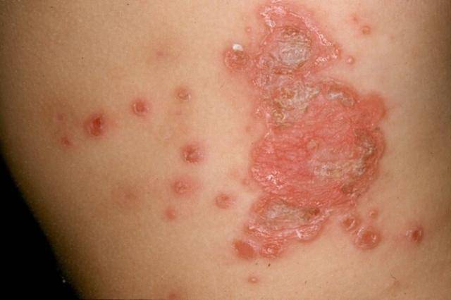 농가진. 의정부을지대병원 제공