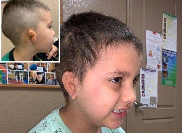 작은귀증 환자의 귀를 재건한 예시 [사진=Congenital Ear Deformity Institute 페이스북]