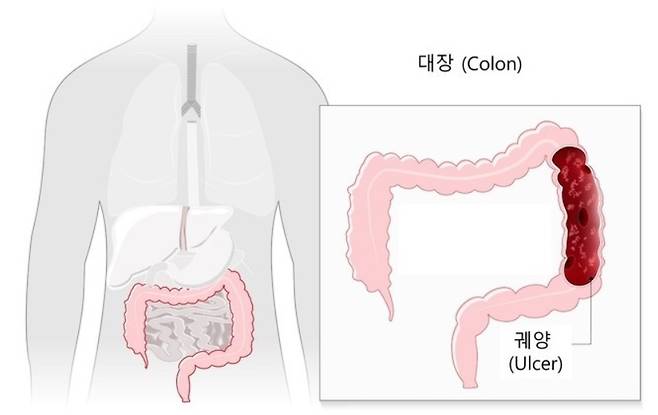 궤양성 대장염 [서울대병원 제공]