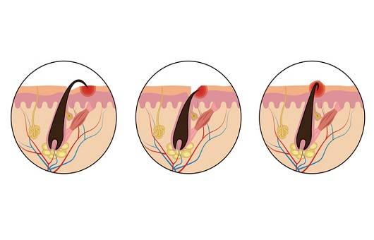 인그로운 헤어｜출처: 게티이미지 뱅크