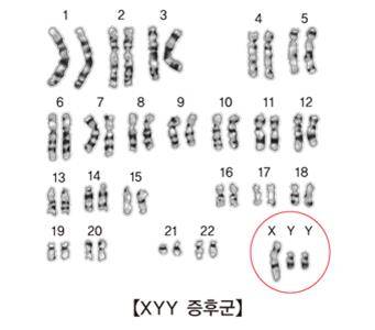 XYY 증후군 [출처: 서울아산병원]