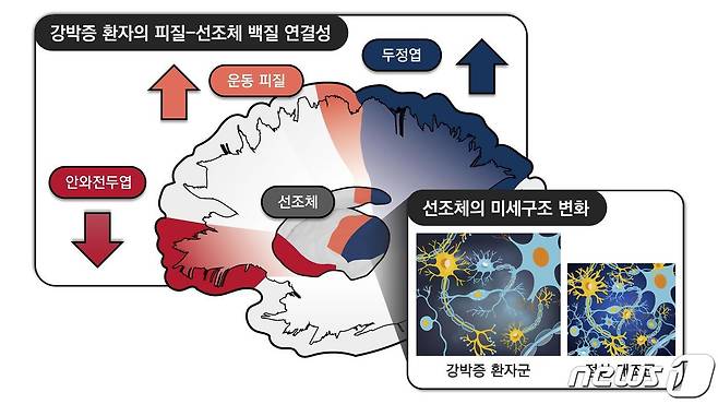 강박증 환자에서 관찰한 대뇌 피질-선조체 회로의 변화 (서울대학교병원 제공) © 뉴스1
