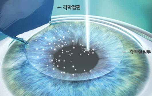 라식 수술 과정ㅣ출처:비앤빛강남밝은세상안과