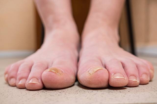발톱이 진한 황색·황갈색으로 변하거나 발톱 밑 각질이 벗겨진다면 ‘발톱 무좀’을 의심할 필요가 있다./사진=게티이미지뱅크