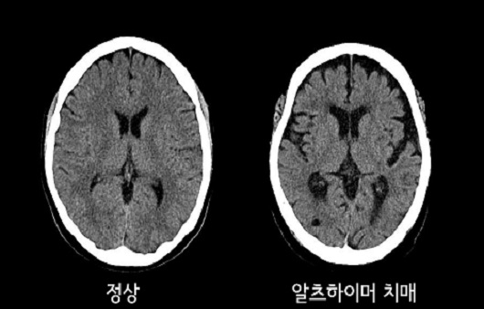 정상적인 뇌와 알츠하이머 치매 환자의 뇌｜출처: 두신경과의원