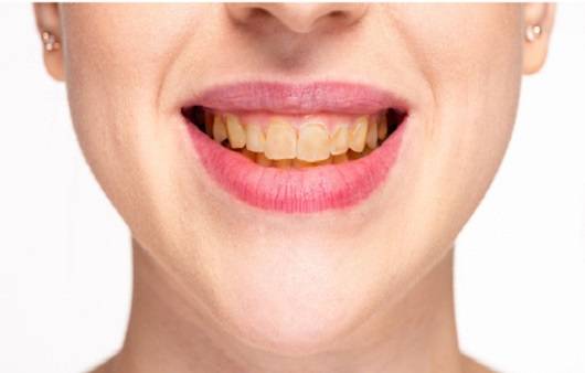 누런 이 | 출처: 게티이미지 뱅크