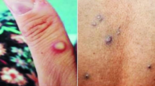 원숭이두창 감염자의 손가락과 몸에 돋아난 피부 발진. 영국보건안전청 홈페이지