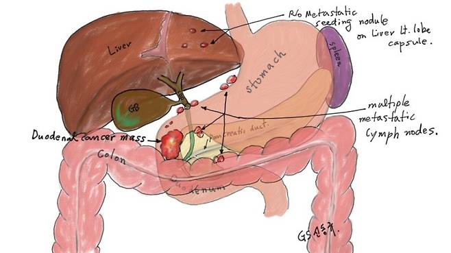 A씨의 십이지장 암 서울적십자병원 외과 신동규(53) 과장이 A씨를 진료하면서 장기 상태를 직접 그린 그림. [신동규 과장 제공]