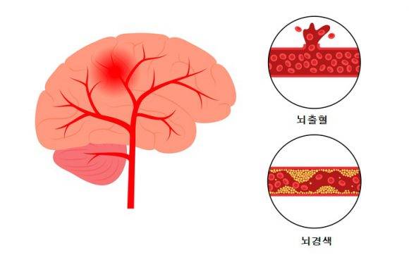 뇌졸중은 크게 혈관이 터지는 뇌출혈, 막히는 뇌경색 두 가지로 나뉜다. [사진= Pikovit44/게티이미지뱅크]