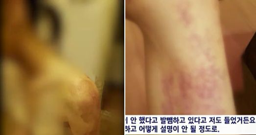 원주 유흥업소 종업원 감금 폭행 피해자들이 업주의 가혹행위 직후 촬영해둔 몸 상태./SBS