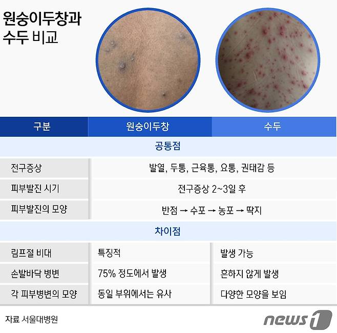 원숭이두창과 수두의 비교 © News1 윤주희 디자이너