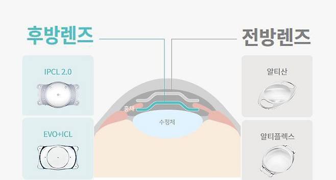 전방렌즈와 후방렌즈ㅣ출처:비앤빛강남밝은세상안과