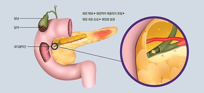 급성 췌장염의 원인 담석. 담석이 오디괄약근에 박혀 췌관을 폐쇄하면 십이지장으로 배출되지 못한 췌장액이 췌장 세포를 손상시켜 염증을 유발한다.