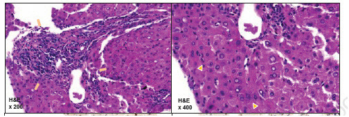 [환자의 간 조직병리학적 소견]  H&E염색 시 간문맥 중증도 염증 및 조각 괴사와 계면간염 확인(왼쪽)/ 간 세포 주위 다른 세포가 부착하여 장미꽃 모양처럼 보이는 로제트형성 확인(오른쪽)