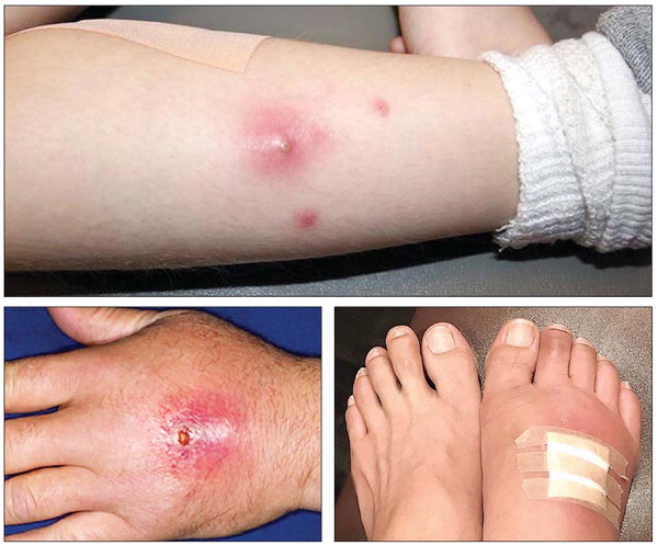 다리와 손, 발가락 등에 연조직염이 발생한 모습.