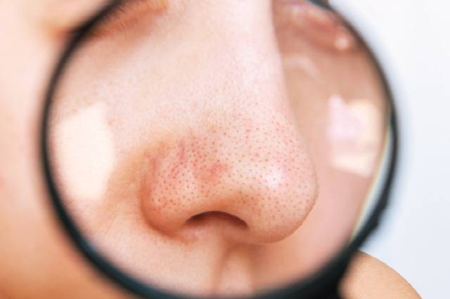 블랙헤드를 영구적으로 없애는 방법은 없으므로, 평소 생활 습관을 개선해 피부에 피지가 쌓이지 않도록 주의해야 한다./사진=게티이미지뱅크