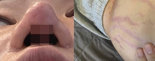 강씨의 현재 코 모양과 장기간의 스테로이드제 치료로 생긴 흉살. ⓒ 뉴스1