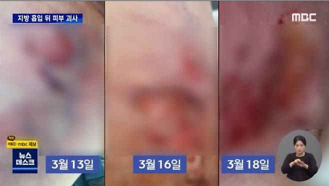 지난 3월 서울 강남의 한 병원에서 지방흡입 수술을 받은 30대 여성이 피부가 괴사했다는 제보가 전해졌다. (사진=MBC)