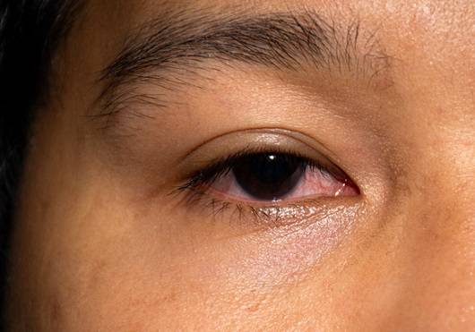 결막염ㅣ출처: 게티 이미지뱅크