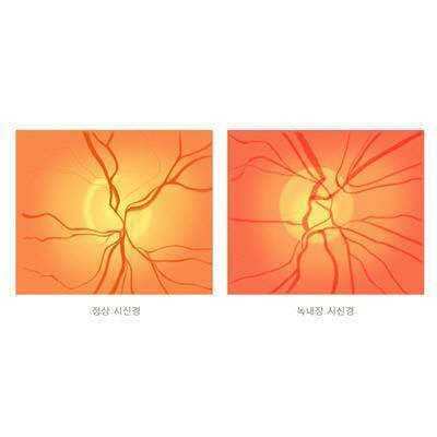 정상 시신경(왼쪽)과 녹내장 시신경(오른쪽). <출처: 삼성서울병원>