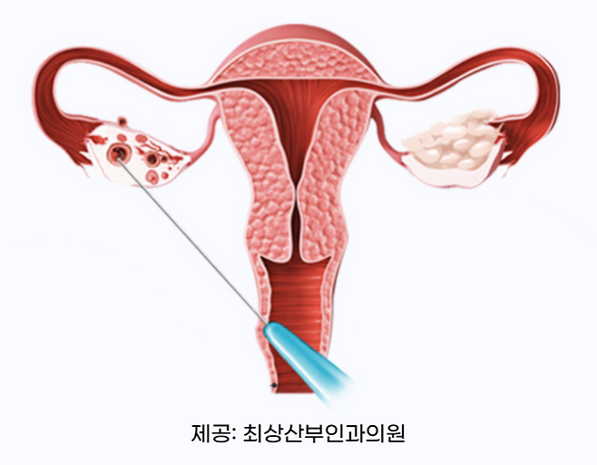 특수 바늘로 난소낭종을 파괴하여 가임력을 보존할 수 있는 ‘경화술’｜출처: 최상산부인과의원