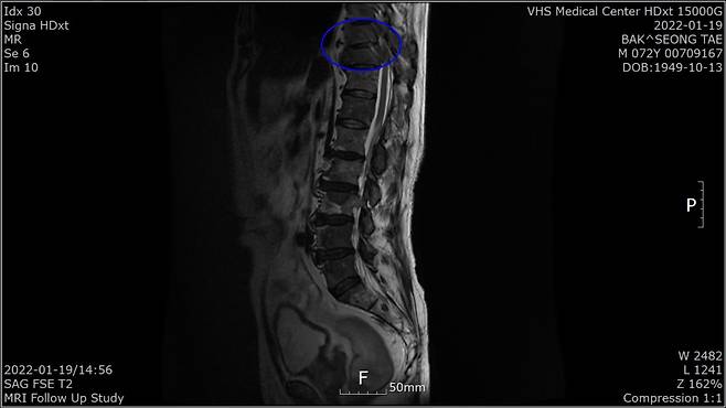 박성태 씨 1월 흉추 9,10번 MRI 사진