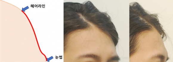 헤어라인과 눈썹이 낮으면 - 돌출-함몰-평평