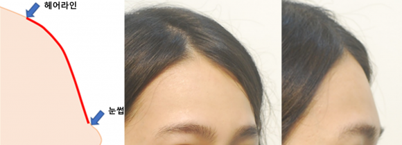 헤어라인과 눈썹이 높으면 매끈- 봉긋한 이마