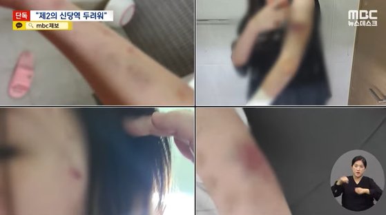 이별을 통보한 연인을 집에 감금하고 5시간 동안 무차별 폭행한 20대 남성이 불구속 상태로 재판에 넘겨졌다. 사진은 폭행 당한 여성의 모습. MBC 영상 캡처