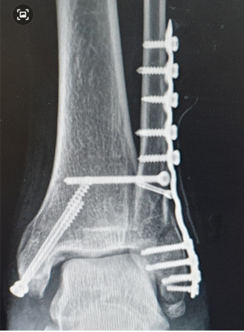 홍종희씨가 2020년 9월 다진 왼발목에 10개가 넘는 핀이 아직도 박혀 있다. 홍종희씨 제공