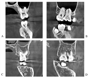 치아 뿌리가 상악동 동굴 내부로 들어간 CBCT 사진 (A,B), 상악동 동굴 내부로 들어가지 않은 CBCT 사진 (C,D) 

A,C는 관상면(신체를 앞뒤로 나누는 가상의 면) B,D는 시상면(신체를 좌우로 나누는 가상의 면)