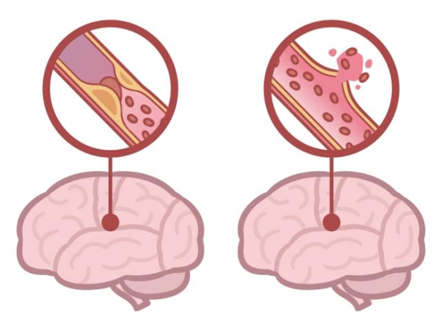 뇌경색(왼쪽)과 뇌출혈(오른쪽). 게티이미지뱅크