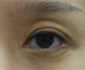 '안검하수'라지만 엄밀히 말해 안검하수인 사람이 그리 많지 않다.