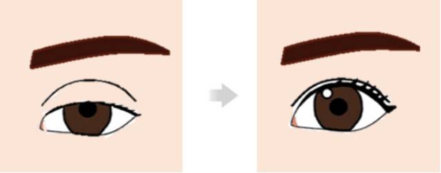 안검하수 교정술