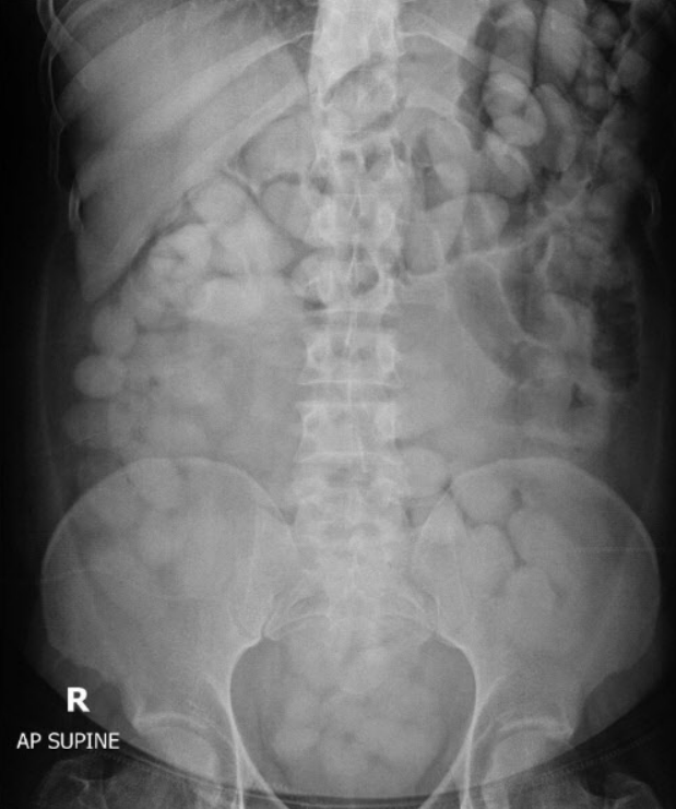마약 밀수범의 몸을 찍은 엑스레이 사진. 태국 세관국 페이스북