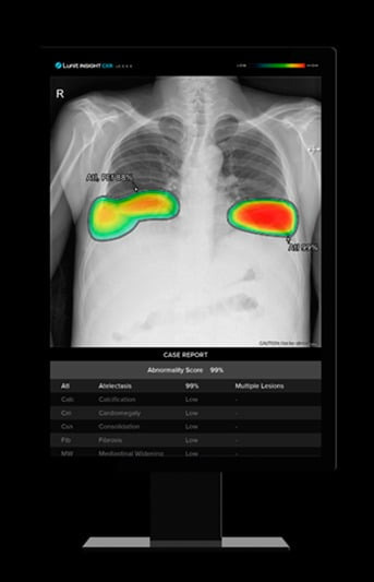 루닛 인사이트 CXR 작동 화면 / 사진 제공=루닛