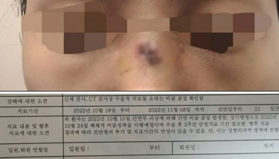 부서진 송판에 맞아 코뼈가 골절된 제보자 A, A씨의 병원 진단서에 "안면부 외상에 의해 안면 비골 골절 발생" "수술 후 3주간 안정가료 기간 필요함"이라는 내용이 적혔다. 연합뉴스(제보자 A씨 제공)