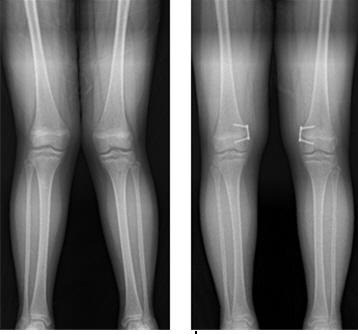 X자형 다리를 8자 금속판 이용한 대퇴골 내측 반성장판 유합술 후 교정된 환자(왼쪽 교정 전, 오른쪽 교정 후) 분당서울대병원 제공