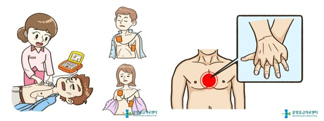 심폐소생술을 할 땐 양 젖꼭지 사이 정중앙을 압박해야 한다, 자동제세동기 전극 패드는 환자의 오른쪽 빗장뼈 바로 아래와, 왼쪽 젖꼭지 옆 겨드랑이의 맨살에 각각 하나씩 부착한다./사진=중앙응급의료센터