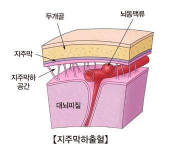 지주막하 출혈 [출처: 서울아산병원]
