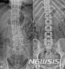 [인천=뉴시스] 이루비 기자 = 강직성척추염(왼쪽)은 정상 척추(오른쪽)와 비교해 관절 없이 하나의 긴 뼈처럼 이어진 모습을 보여 '대나무 척추(bamboo spine)'로도 불린다. (사진=가톨릭대학교 인천성모병원 제공) 2022.11.02. photo@newsis.com *재판매 및 DB 금지