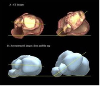 모바일 진단 애플리케이션을 통해 재건한 3차원 사진(하단부). 3차원 CT 사진(상단부)과 비교해 정확도 높은 영상을 구현한 것을 확인할 수 있다.