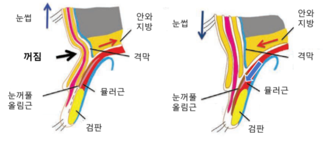 눈을 뜨는 근육을 강화시키면, 말려들어갔던 지방도 함께 내려온다. / Plast Reconstr Surg Glob Open 2017;5:e1616