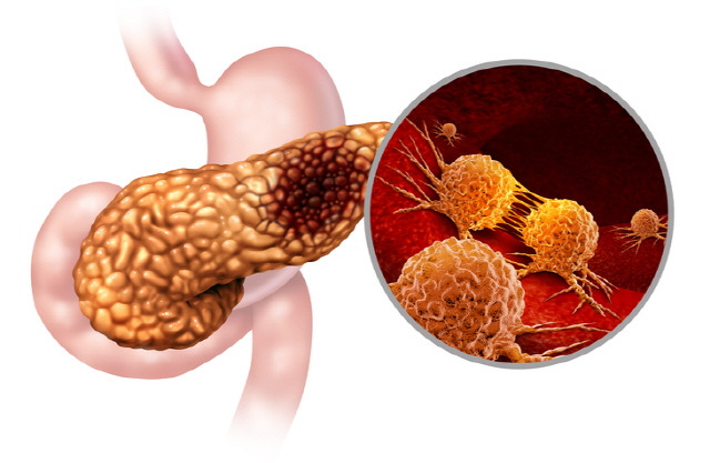 혈당과 체중을 주기적으로 확인하면 조기에 췌장암을 발견할 수 있다는 연구 결과가 나왔다./사진=게티이미지 뱅크